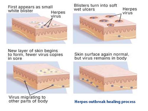 What does healing from a herpes outbreak look like